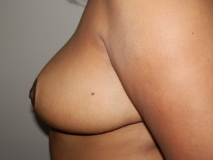 Breast Reduction - Case 0137 - after side view